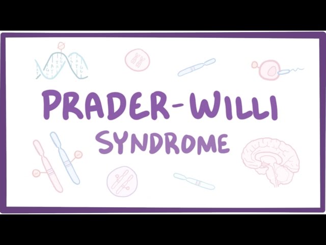 Prader Willi Syndrome Causes Symptoms Diagnosis Treatment 3192 The