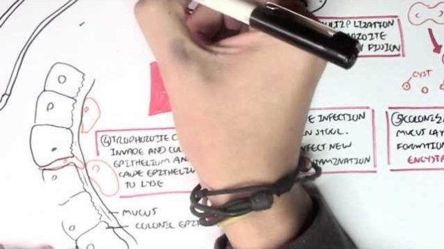 Amoebic dysentery – Entamoeba Histolytica