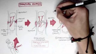 Bone Fracture – Types, Fracture Repair and Osteomyelitis