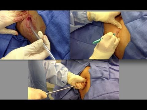 Chest Tube Placement