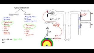 ✔ Conn’s syndrome (Primary Hyperaldosteronism) – MADE EASY