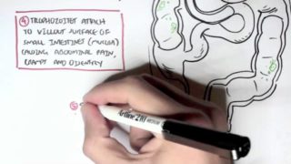 Giardiasis – Giardia Lamblia