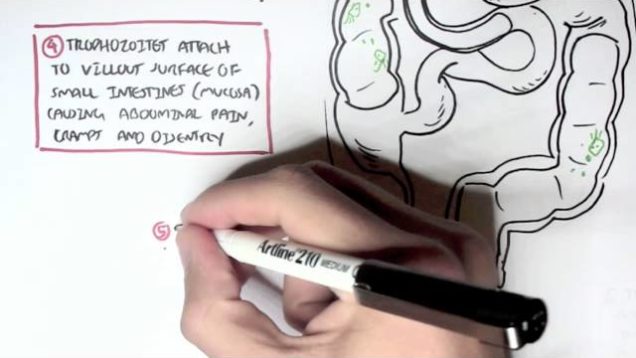 Giardiasis – Giardia Lamblia