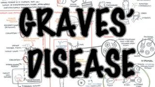 Graves Disease (DETAILED) – Overview