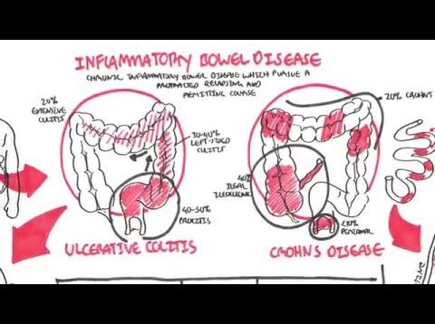 Inflammatory Bowel Disease – Crohns and Ulcerative Colitits