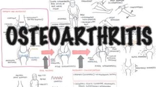 Osteoarthritis (DETAILED) Overview
