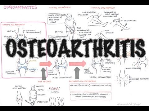 Osteoarthritis (DETAILED) Overview