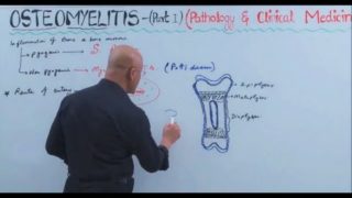 Osteomyelitis