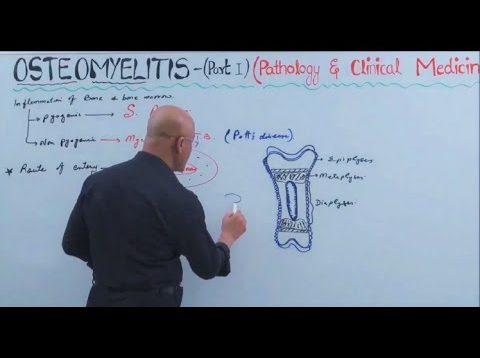 Osteomyelitis