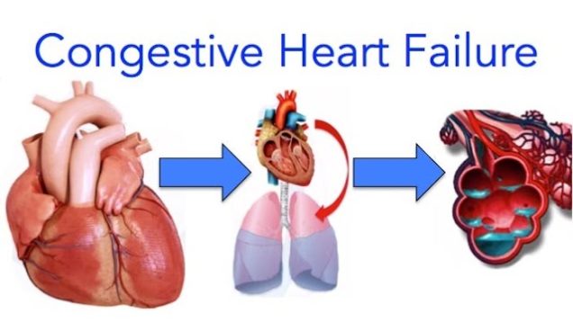 Congestive Heart Failure (CHF) Signs and Symptoms, Diagnosis and Treatment