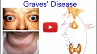 ✔ Graves’ Disease – Hyperthyroidism – Everything You Need to Know – MADE EASY