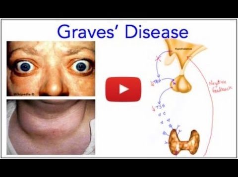 ✔ Graves’ Disease – Hyperthyroidism – Everything You Need to Know – MADE EASY