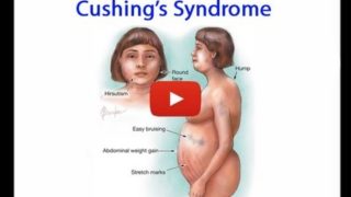 Cushing Syndrome aka Hypercortisolism Made Easy – Free Medical Videos