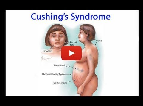 Cushing Syndrome aka Hypercortisolism Made Easy – Free Medical Videos