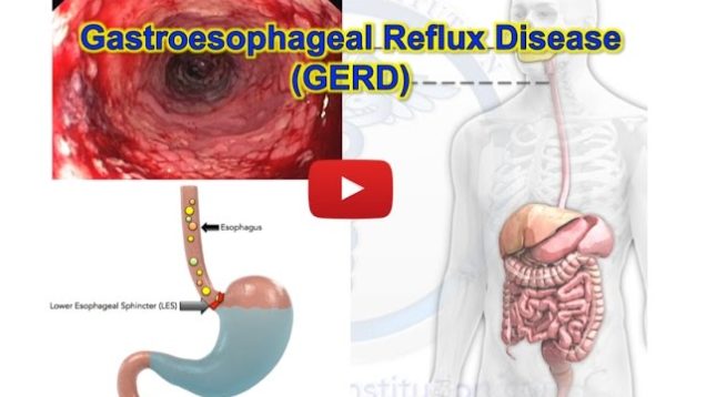 GERD, Gastroesophageal reflux disease, Heartburn; MADE EASY, Medical institution, Free medical videos,