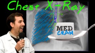 Chest X-Ray Interpretation Explained Clearly by MedCram.com