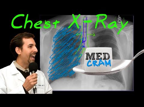 Chest X-Ray Interpretation Explained Clearly by MedCram.com