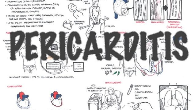 Pericarditis – Overview