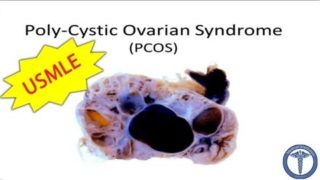 Polycystic Ovarian Syndrome (PCOS)