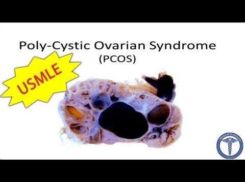 Polycystic Ovarian Syndrome (PCOS)
