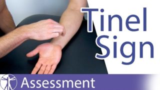 Tinel Sign: Wrist⎟Carpal Tunnel Syndrome Tinel Sign: Wrist⎟Carpal Tunnel Syndrome