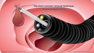 what-is-colonoscopy-colorectal-cancer-screening