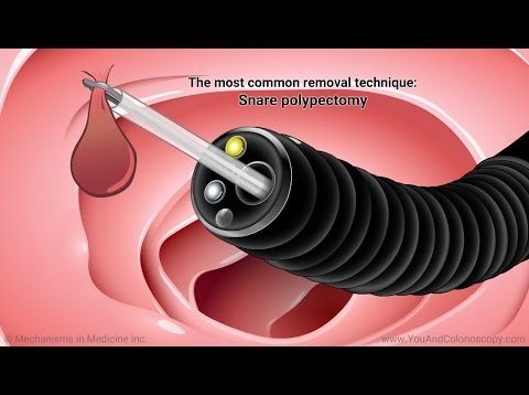 what-is-colonoscopy-colorectal-cancer-screening