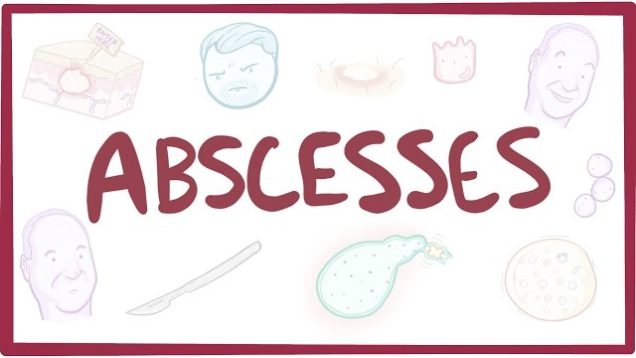 Abscesses – causes, symptoms, diagnosis, treatment, pathology