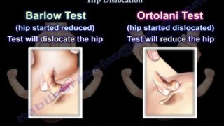 Barlow & Ortolani test, Congenital Hip Dislocation- Everything You Need To Know – Dr. Nabil Ebraheim