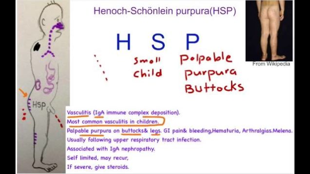 Henoch–Schönlein Purpura Mnemonic
