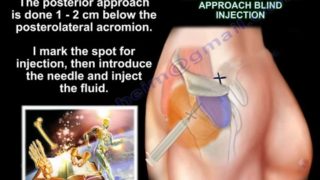 Injections Around The Shoulder – Everything You Need To Know – Dr. Nabil Ebraheim