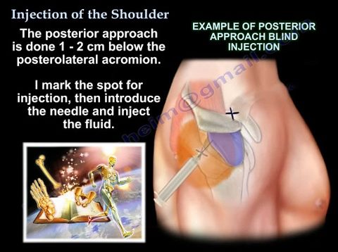 Injections Around The Shoulder – Everything You Need To Know – Dr. Nabil Ebraheim