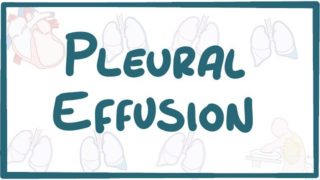 Pleural Effusion – causes, symptoms, diagnosis, treatment, pathology