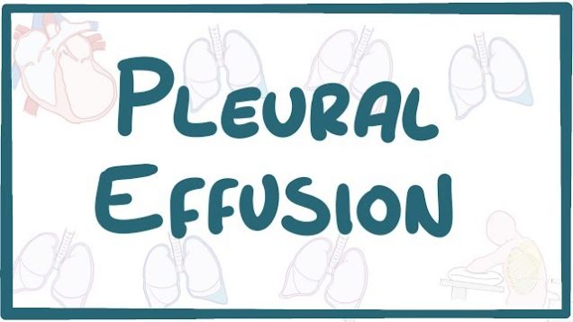 Pleural Effusion – causes, symptoms, diagnosis, treatment, pathology