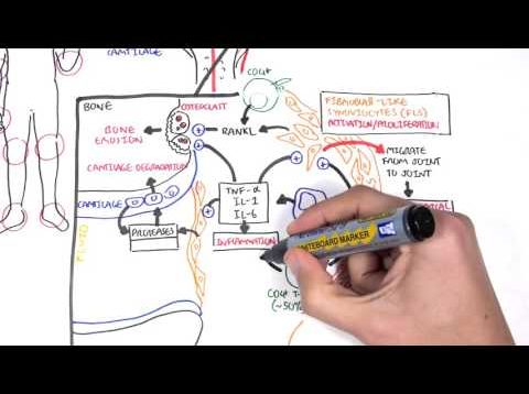 Rheumatoid Arthritis Pathophysiology