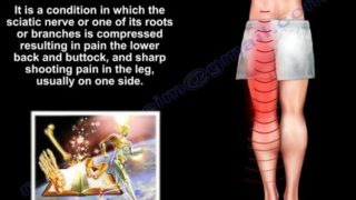 Sciatica – Everything You Need To Know – Dr. Nabil Ebraheim