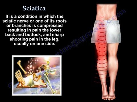 Sciatica – Everything You Need To Know – Dr. Nabil Ebraheim