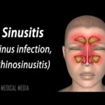 Sinusitis, Animation.