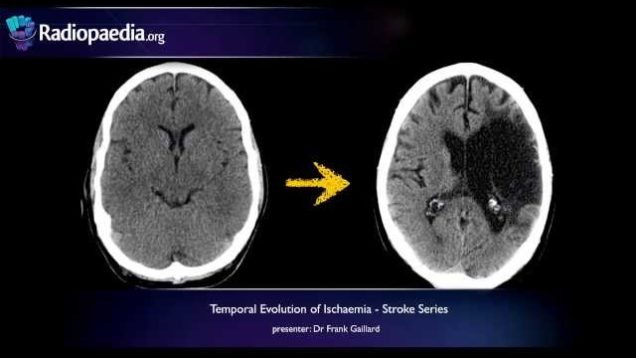 Stroke: Evolution from acute to chronic infarction – radiology video tutorial (CT, MRI)