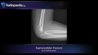 Supracondylar fracture – radiology video tutorial (x-ray)
