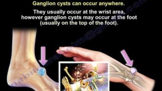 Ganglion Cyst Of The Foot – Everything You Need To Know – Dr. Nabil Ebraheim
