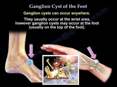 Ganglion Cyst Of The Foot – Everything You Need To Know – Dr. Nabil Ebraheim