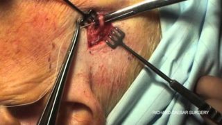 temporalarterybiopsy
