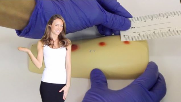 Administering & Checking a PPD! Nursing Skills :)