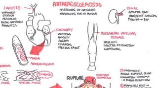 Atherosclerosis – Pathophysiology