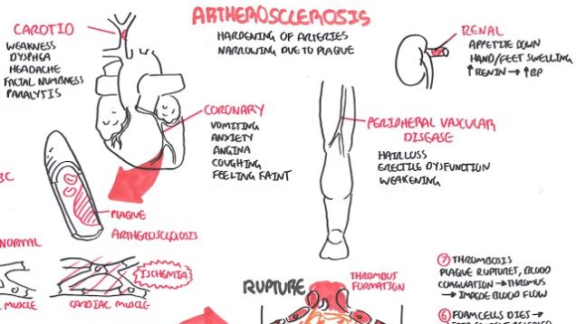 Atherosclerosis – Pathophysiology