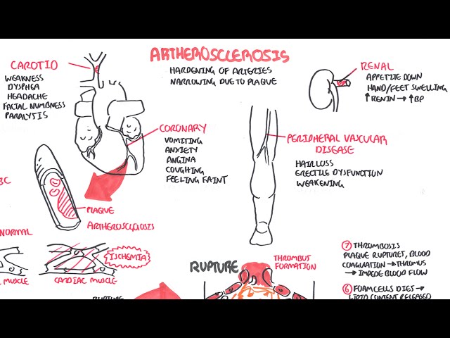 Atherosclerosis - Pathophysiology - Free Medical Videos
