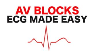 AV Blocks (1st, 2nd, and 3rd Degree)