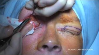 blepharoplasty