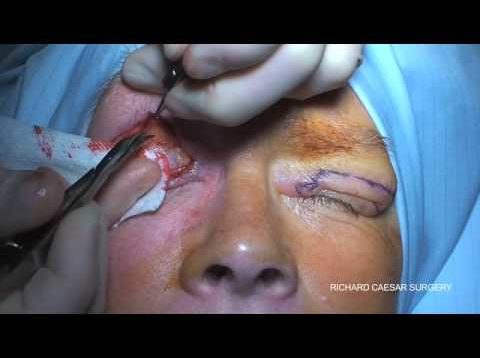 blepharoplasty
